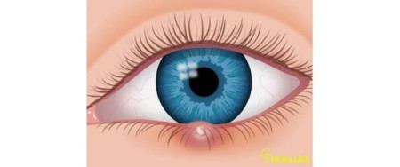 Κριθαράκι στο μάτι: Τι κάνουμε όταν βγαίνει εσωτερικά και τι εξωτερικά