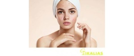 Πώς να Αντιμετωπίσετε την Ακμή