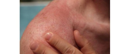 Προσοχή: Τι σημαίνει αν ο ήλιος σας προκαλέσει φαγούρα και εξάνθημα